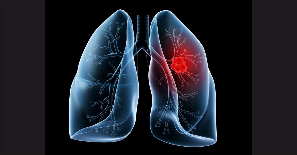 Discovery of distinct lung cancer prognosis may lead to more targeted treatments